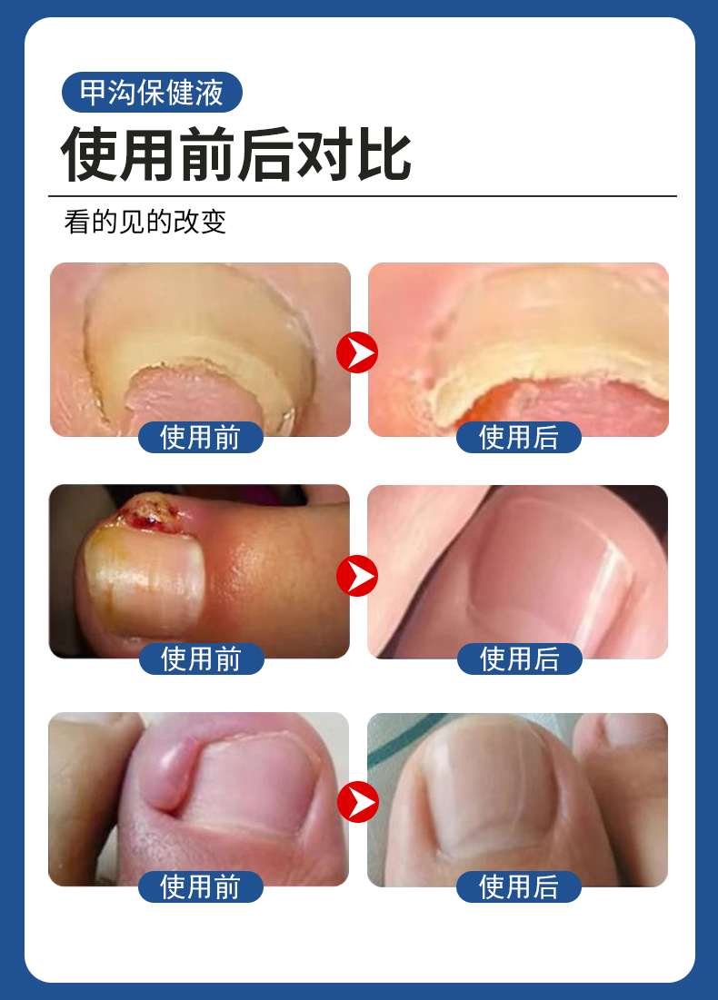 甲溝炎專(zhuān)用液有用嗎？使用前后對(duì)比